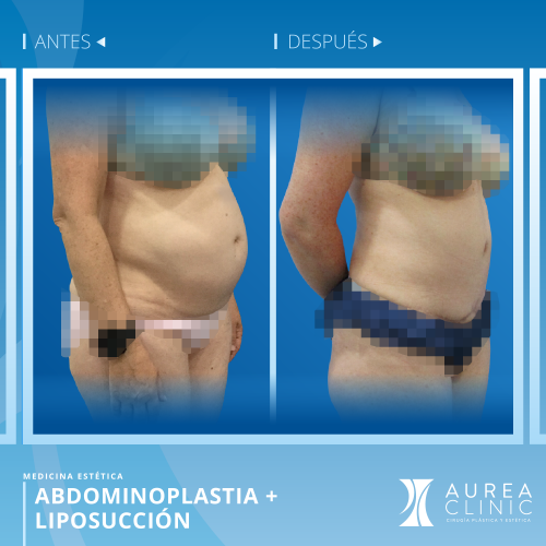 Abdominoplastia + Liposucci�n Agualipo